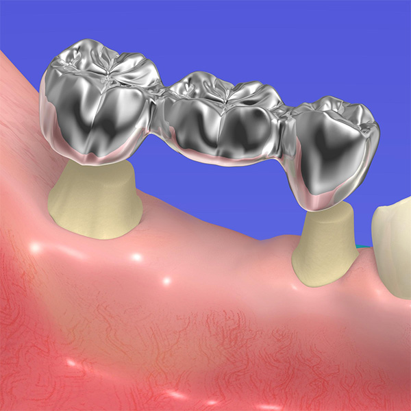 ブリッジでお悩みの方