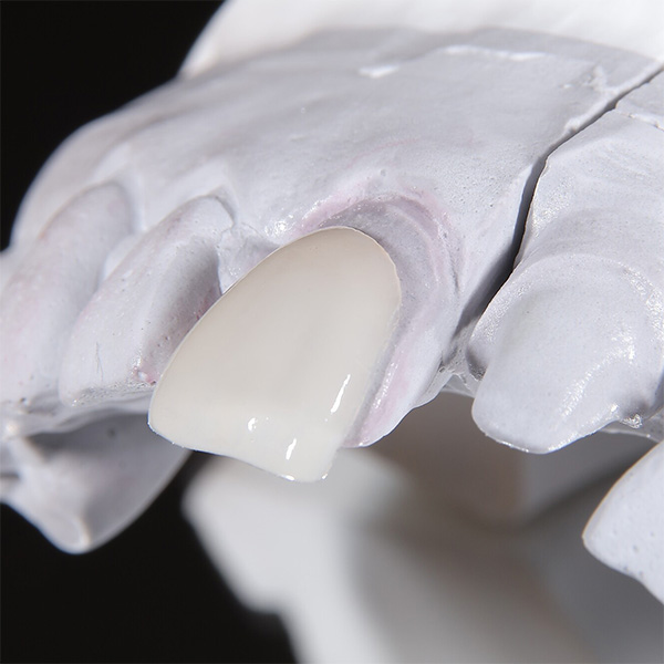 ラミネートベニアでお悩みの方