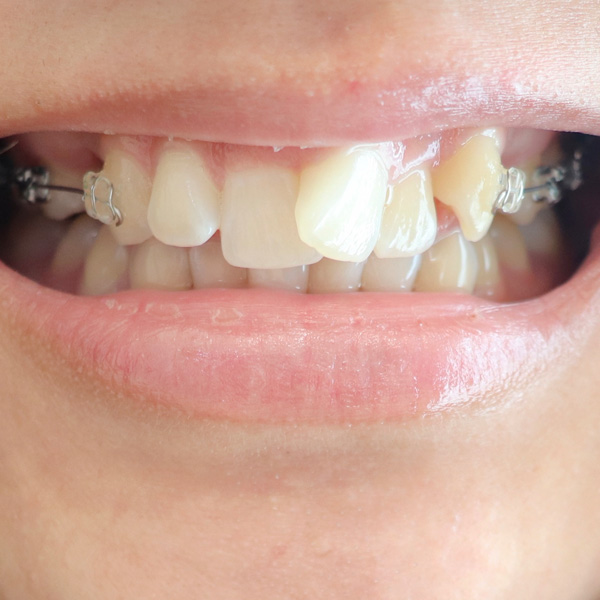 歯並びのことでお悩みの方