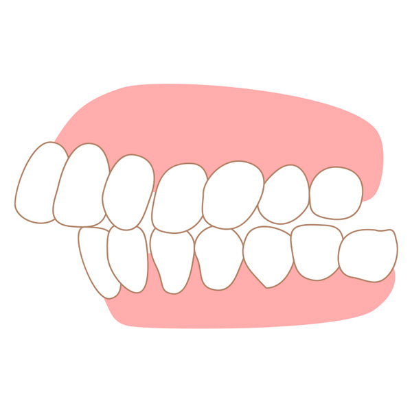 出っ歯のことでお悩みの方