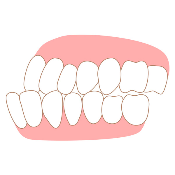 受け口のことでお悩みの方