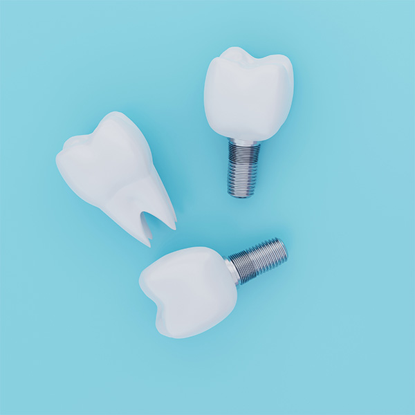 インプラントでお悩みの方